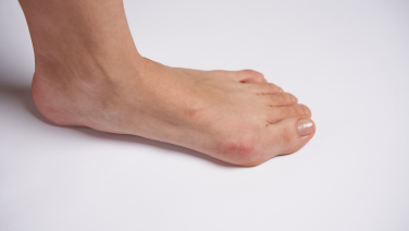 Hallux Valgus - Une déformation du gros orteil : Causes, symptômes et traitement