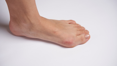 Hallux valgus – Une déformation du gros orteil : causes, symptômes et informations